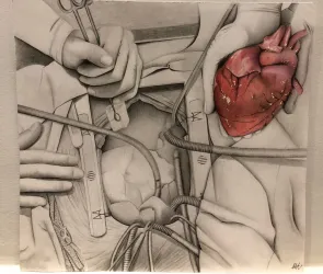 Drawing of a heart transplant operation